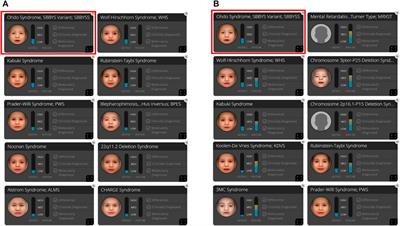 Case Report: The success of face analysis technology in extremely rare genetic diseases in Korea: Tatton–Brown–Rahman syndrome and Say–Barber –Biesecker–Young–Simpson variant of ohdo syndrome